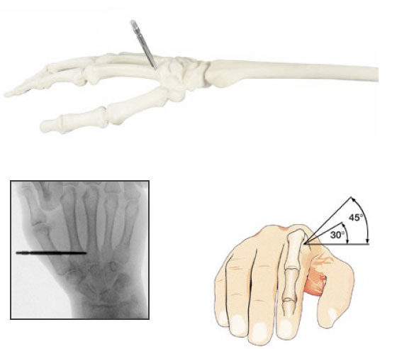 insertion vis métacarpien