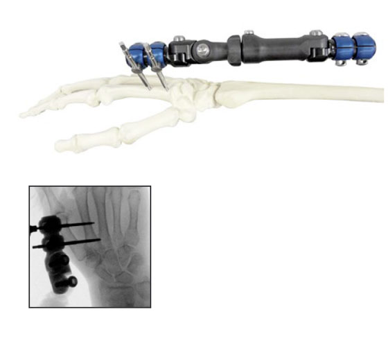 insertion vis metacarpe