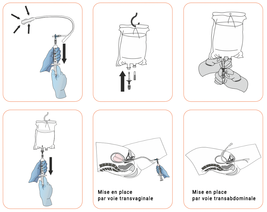 utilisation de la sonde Post-partum